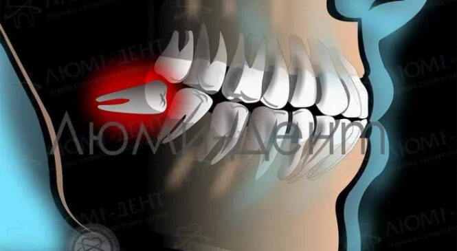 Якими бувають і про що говорять симптоми зуба мудрості